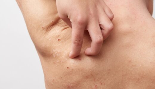 アトピーが当院の整体で改善する理由とは？